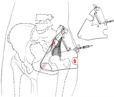 Application of 3D printing individualized guide plates in percutaneous needle biopsy of acetabular tumors